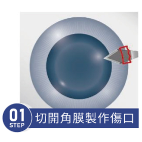傳統白內障手術 STEP 01