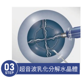 傳統白內障手術 STEP 03