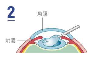 撕取水晶體前囊
