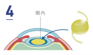 植入人工水晶體